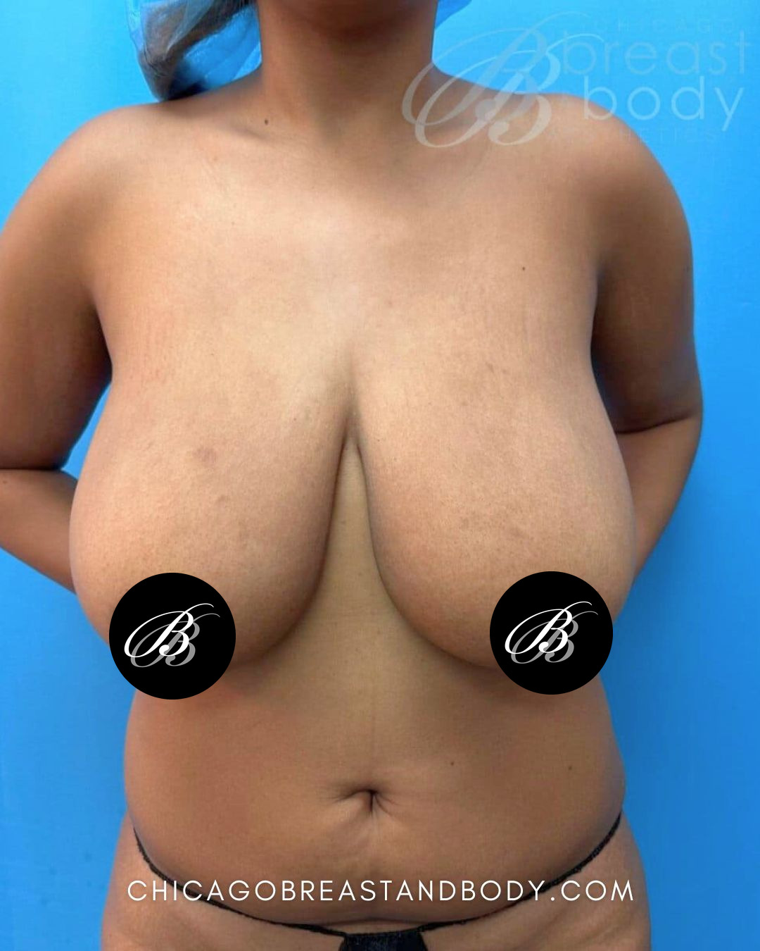 Before photo of a breast reduction patient of Dr. Kevin Lin