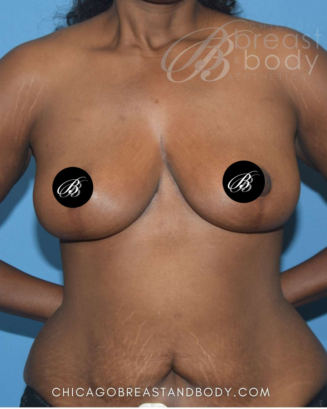After photo of a breast reduction patient of Dr. Anh-Tuan Truong