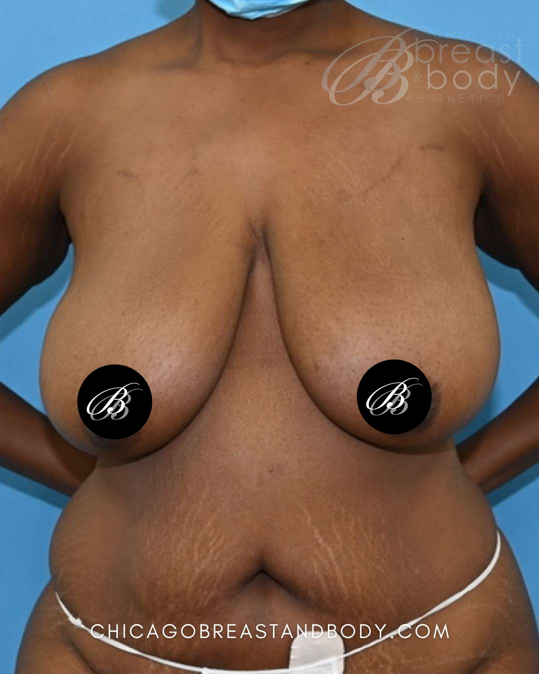 Before photo of a breast reduction patient of Dr. Anh-Tuan Truong