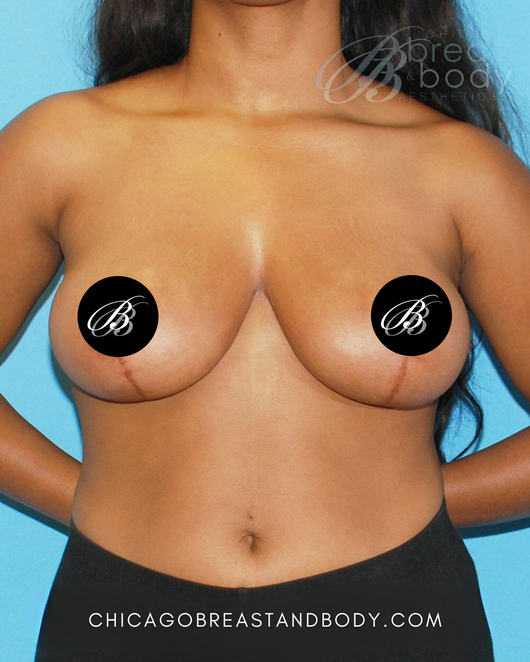 After photo of a breast reduction patient of Dr. Anh-Tuan Truong, case 6521