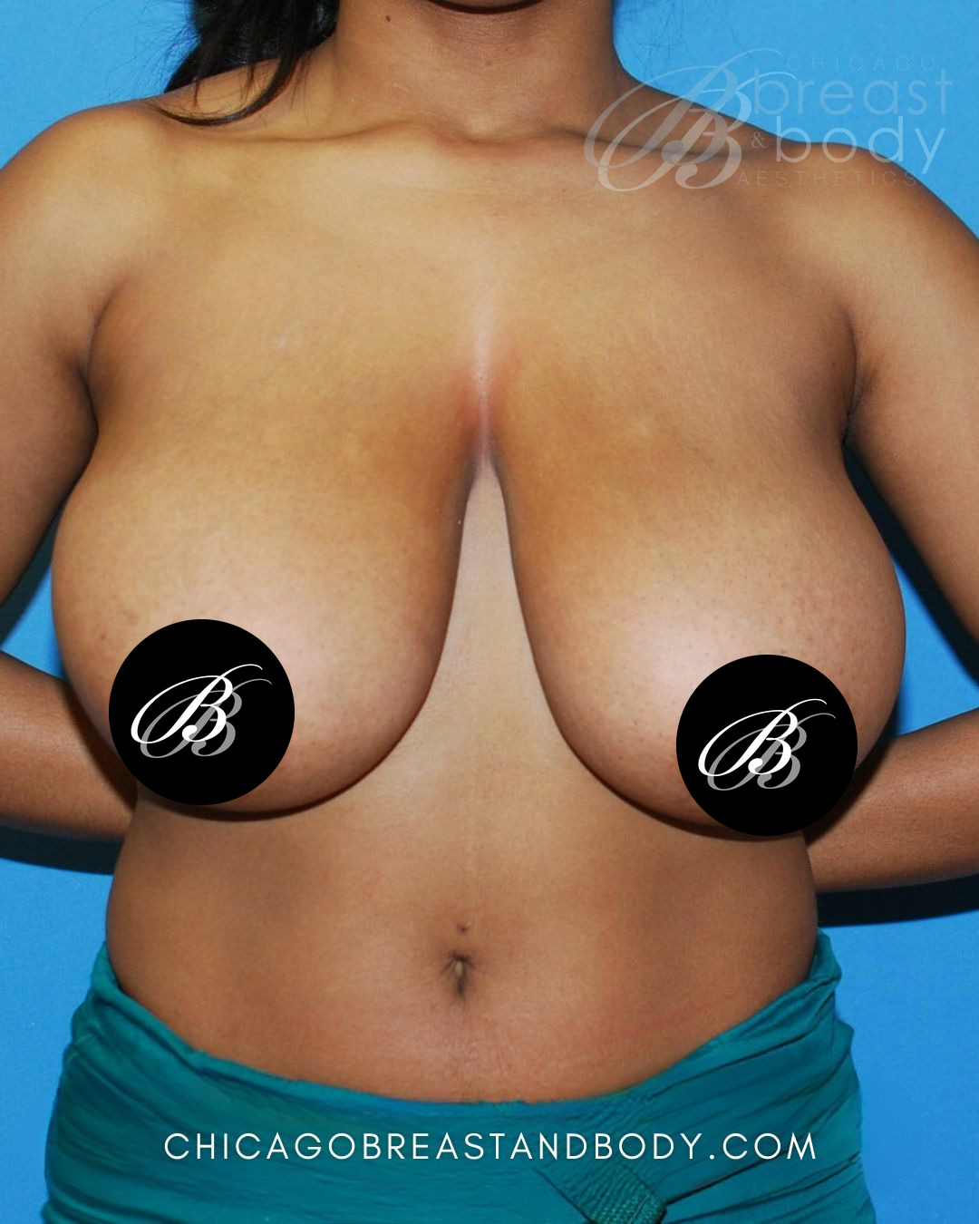 Before photo of a breast reduction patient of Dr. Anh-Tuan Truong, case 6521