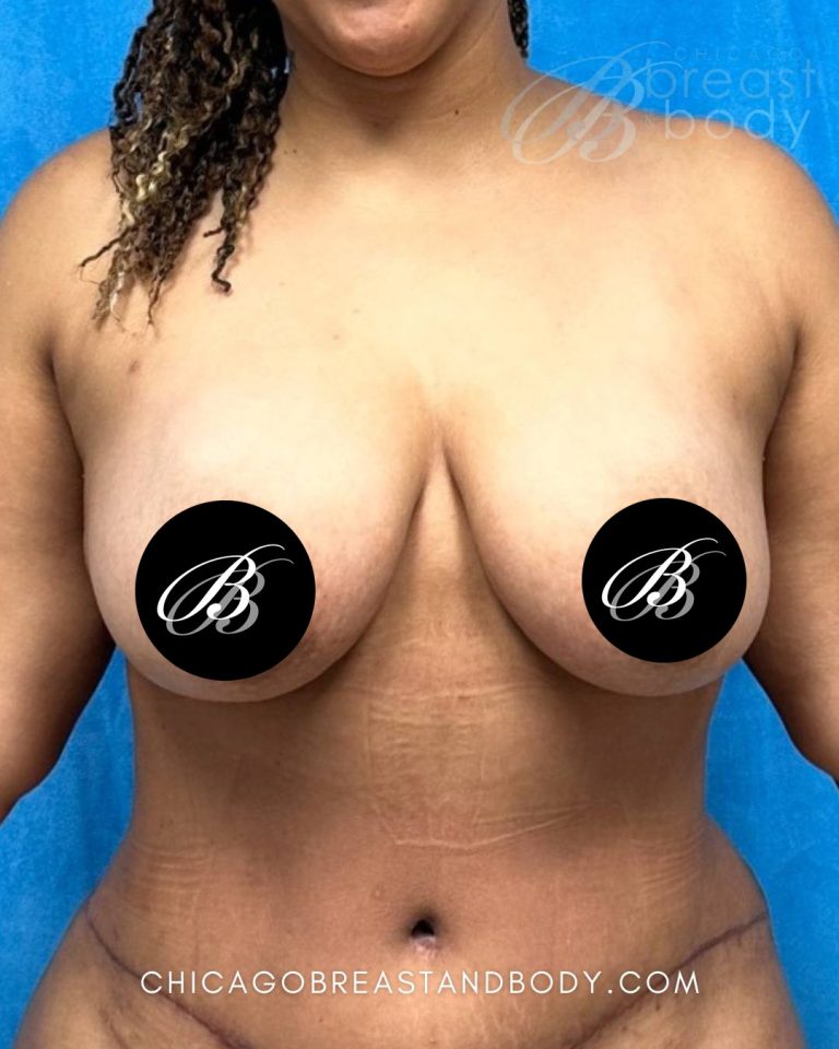 Fat transfer to breasts after photo, case 2298287, actual patient of Dr. Anh-Tuan Truong in Chicago