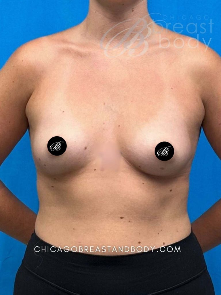 Fat transfer to breasts before photo, case 2384118, actual patient of Dr. Anh-Tuan Truong in Chicago