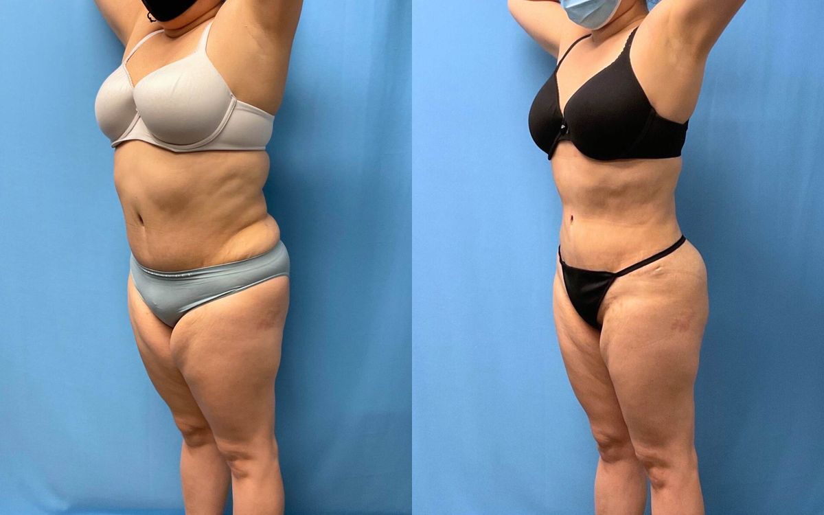 Lipo 360 Transforms & Slims Your Waistline