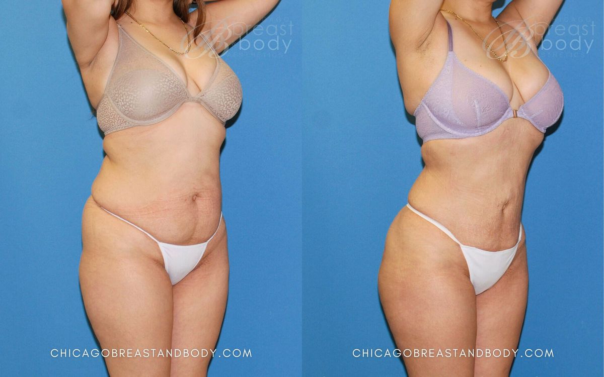 Lipo 360 before and after, front angle view, case 484, actual patient of Dr. Anh-Tuan Truong at Chicago Breast and Body Aesthetics