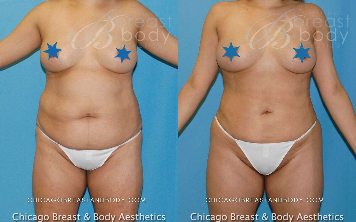 Lipo 360 before and after, front view, case 522, actual patient of Dr. Anh-Tuan Truong at Chicago Breast and Body Aesthetics