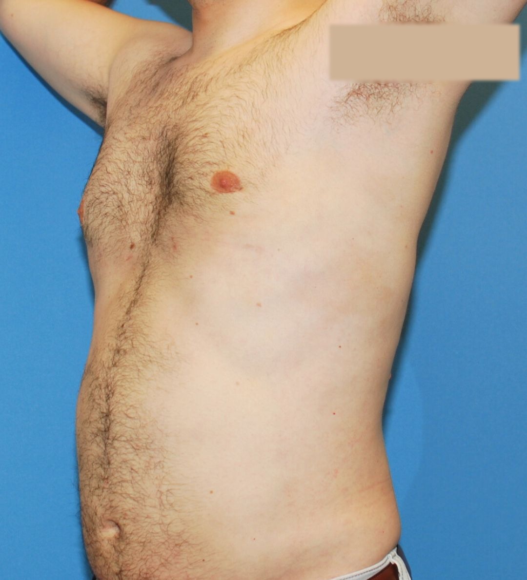 After male breast reduction photo, case 1744161, patient of Dr. Anh-Tuan Truong, oblique view
