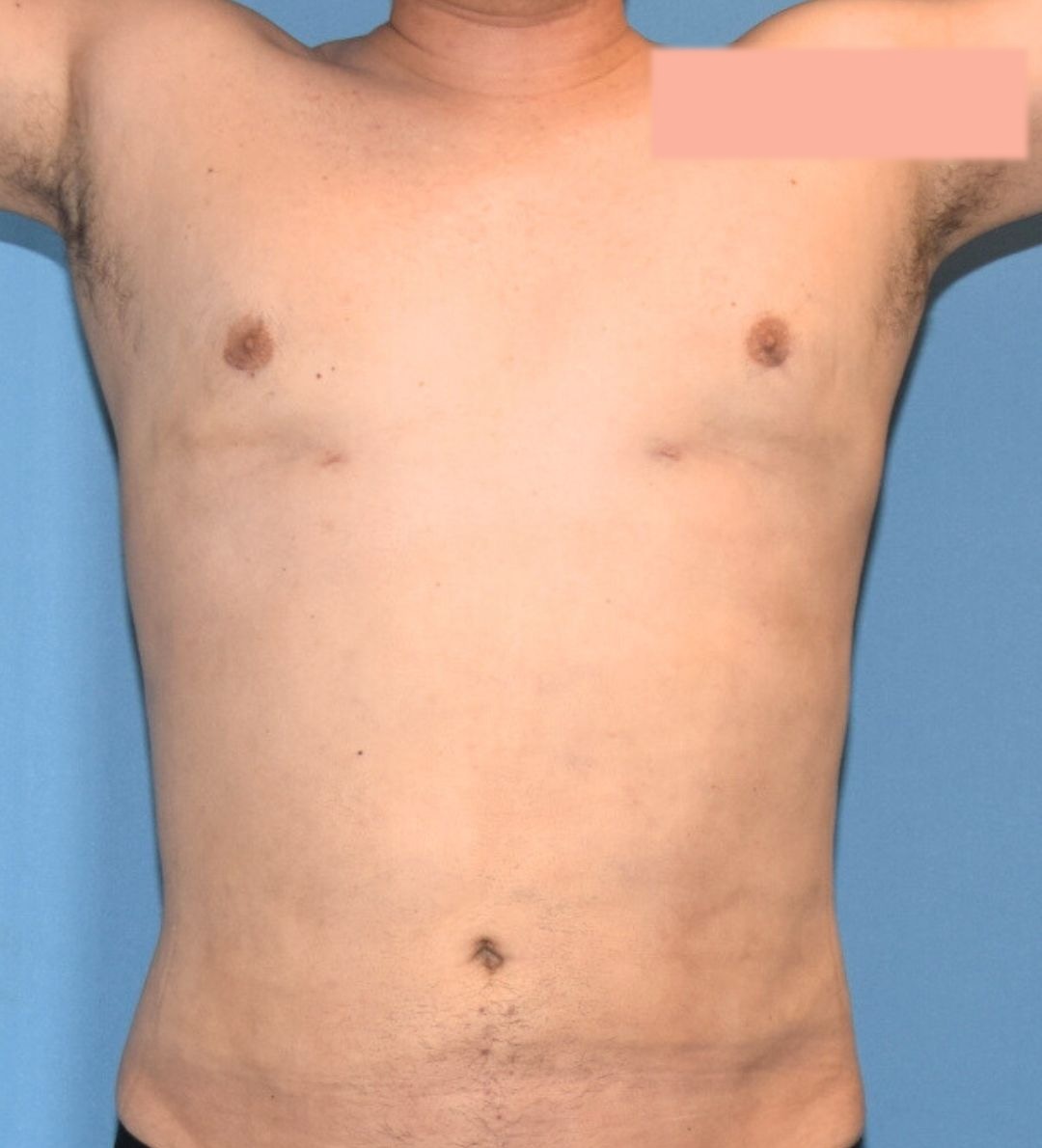 After male breast reduction photo, case 18452800, patient of Dr. Anh-Tuan Truong, front view