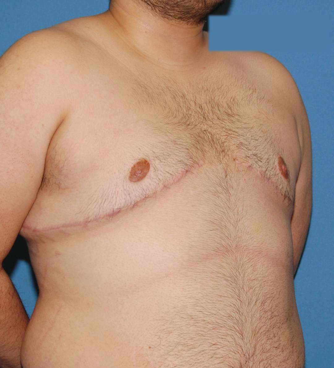 After male breast reduction (Grade 4 gynecomastia), case 29000, patient of Dr. Anh-Tuan Truong, front view