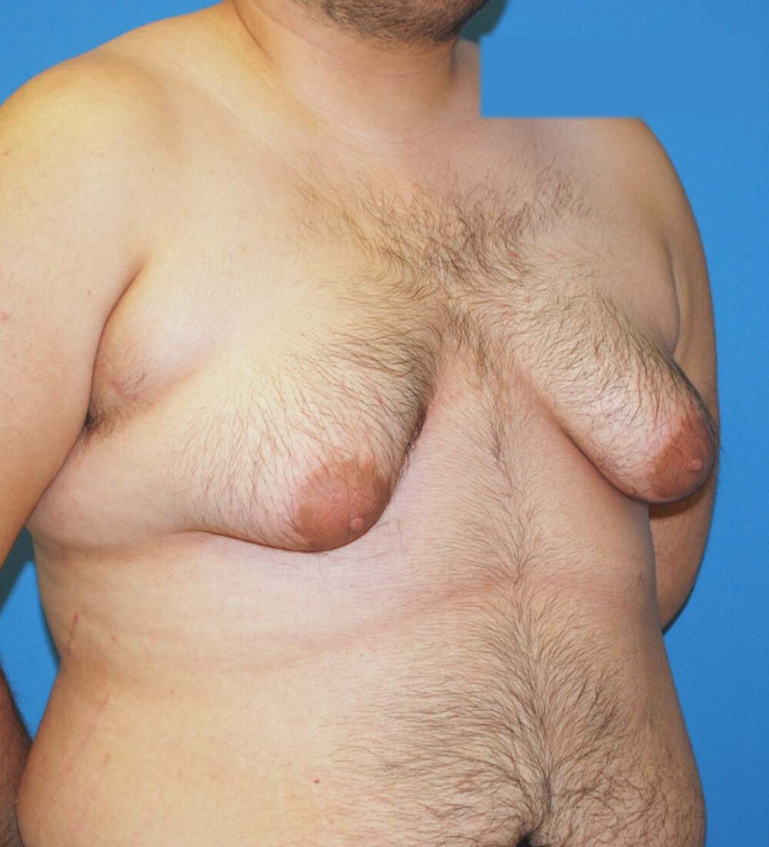 Before male breast reduction photo, case 29000, patient of Dr. Anh-Tuan Truong, front view