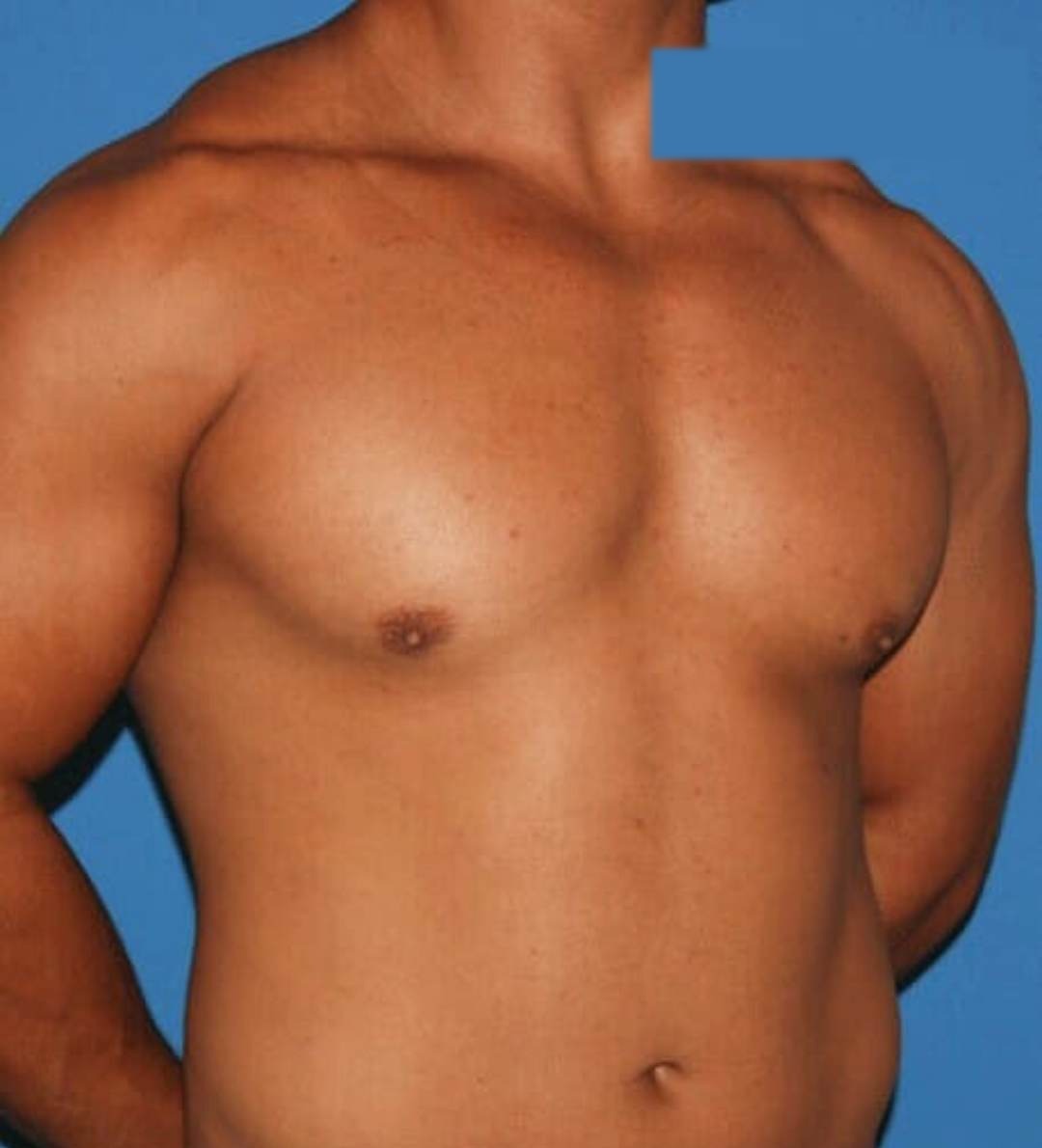 After male breast reduction photo, case 408B, patient of Dr. Anh-Tuan Truong, oblique view