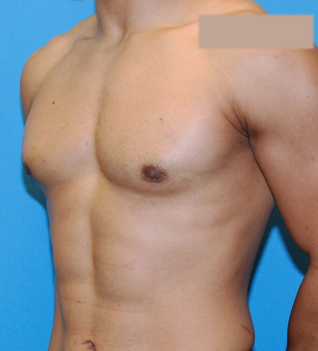 After male breast reduction photo, case 43000, patient of Dr. Anh-Tuan Truong, oblique view