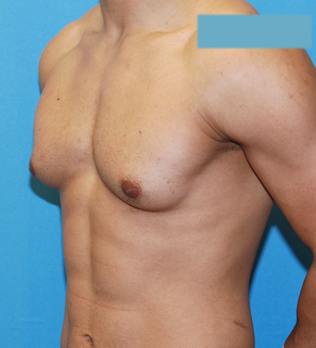 Before male breast reduction photo, case 43000, patient of Dr. Anh-Tuan Truong, oblique view