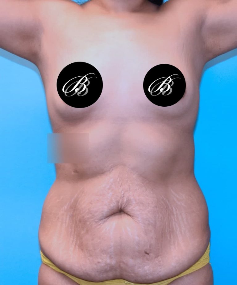 Before mommy makeover photo, case 1665493, patient of Dr. Kevin Lin, front view