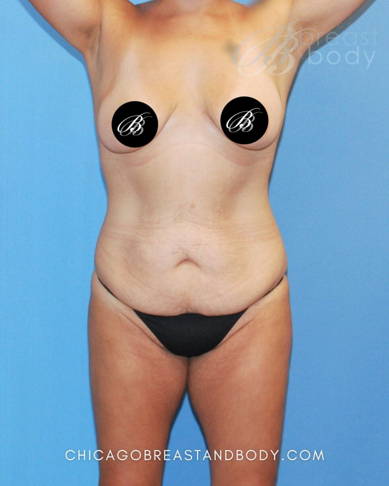 Before mommy makeover photo, case 1741181, patient of Dr. Anh-Tuan Truong, front view