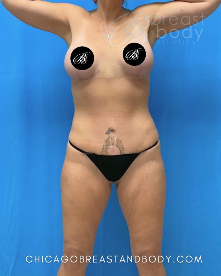 After mommy makeover photo, case 2014390, patient of Dr. Kevin Lin, front view