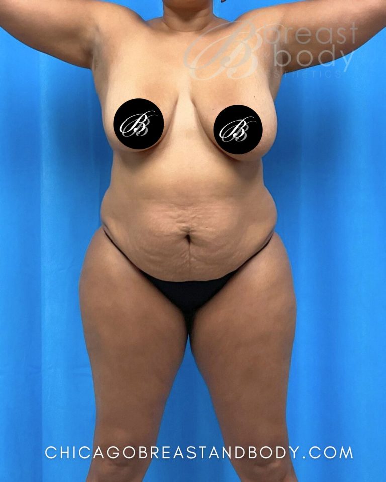 Before mommy makeover photo, case 2190579, patient of Dr. Kevin Lin, front view