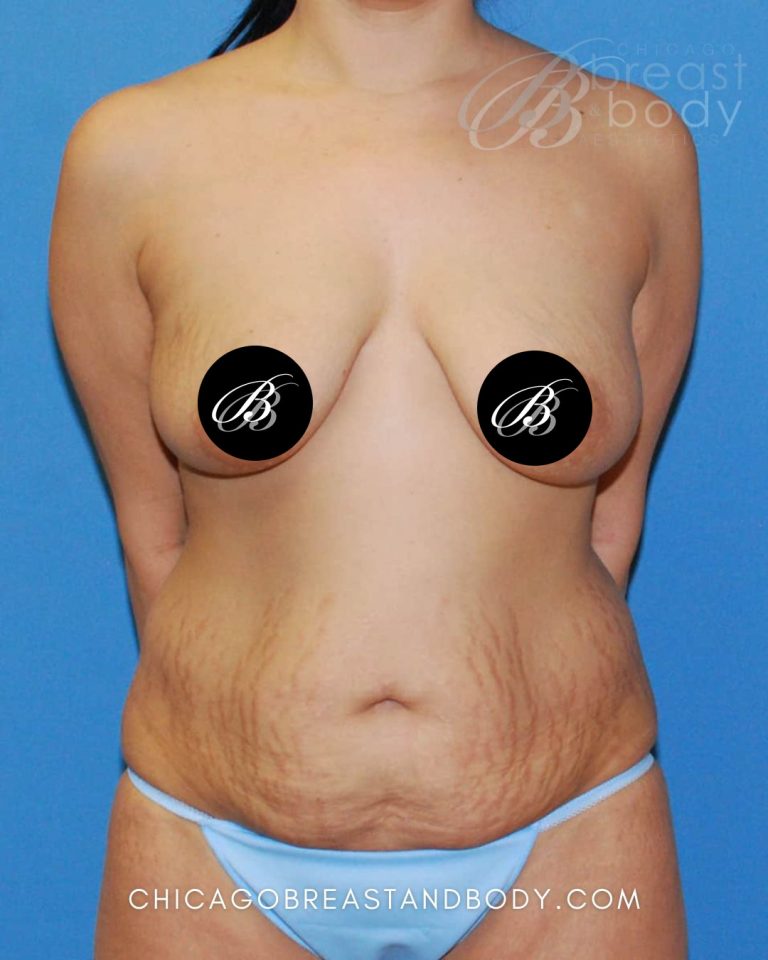 Before mommy makeover photo, case 35646, patient of Dr. Anh-Tuan Truong, front view