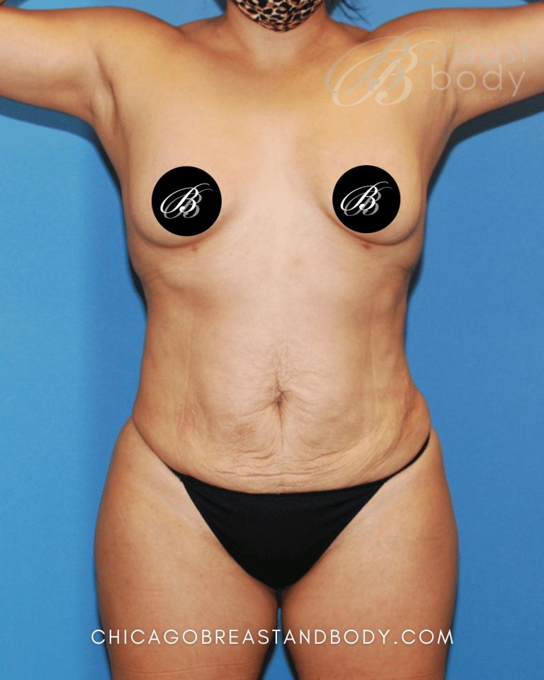 Before mommy makeover photo, case 807, patient of Dr. Anh-Tuan Truong, front view