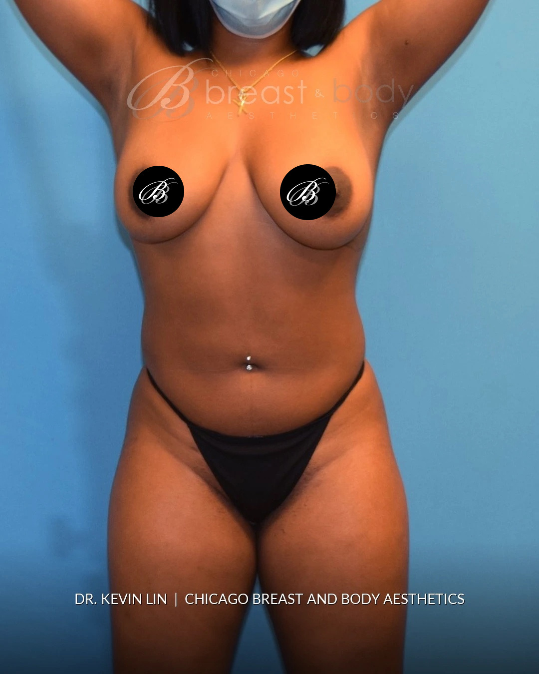 Lipo 360, Liposuction after photo, front view, case #1540321, Dr. Kevin Lin, Chicago Breast & Body