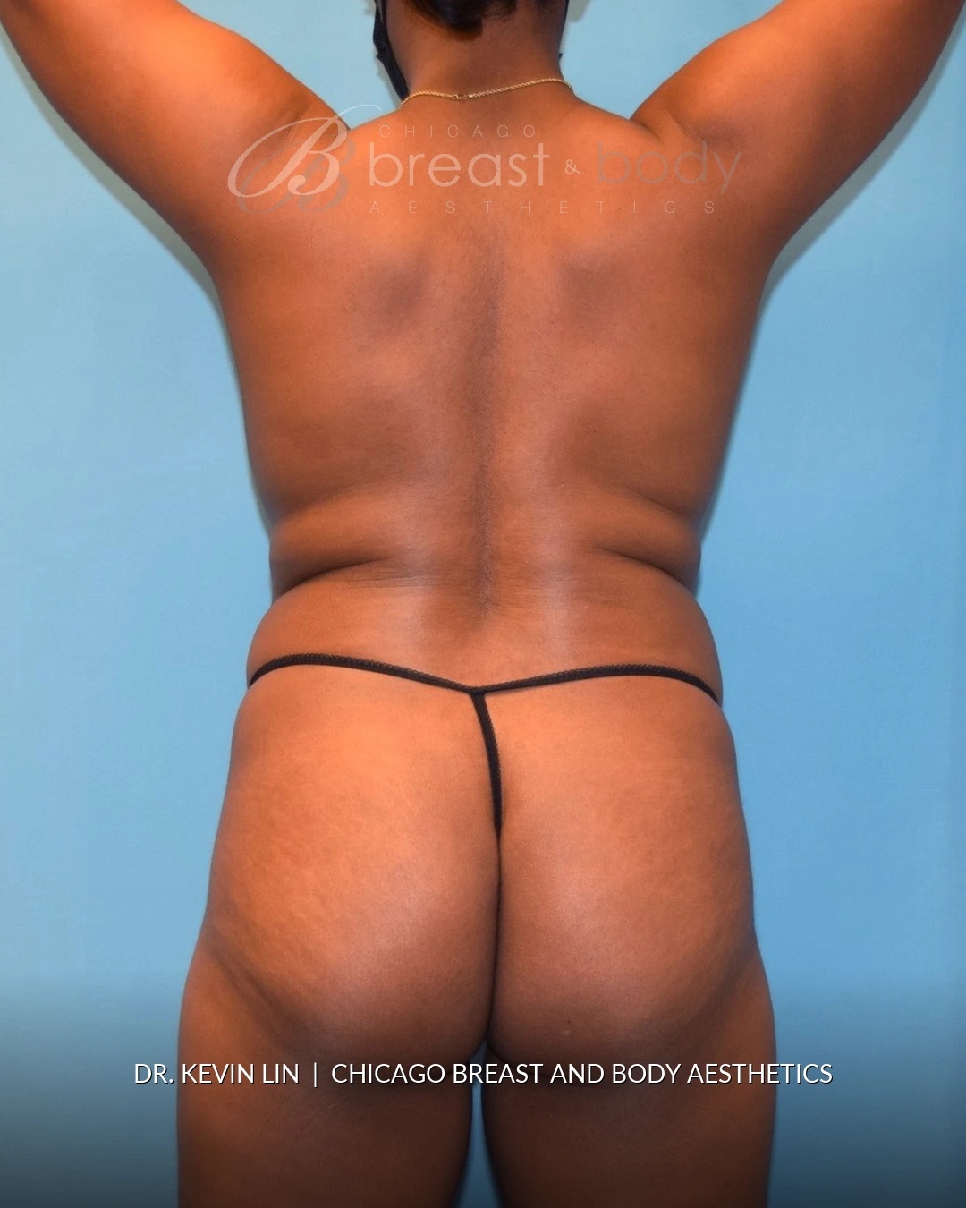 Lipo 360, Liposuction before photo, back view, case #1540321, Dr. Kevin Lin, Chicago Breast & Body
