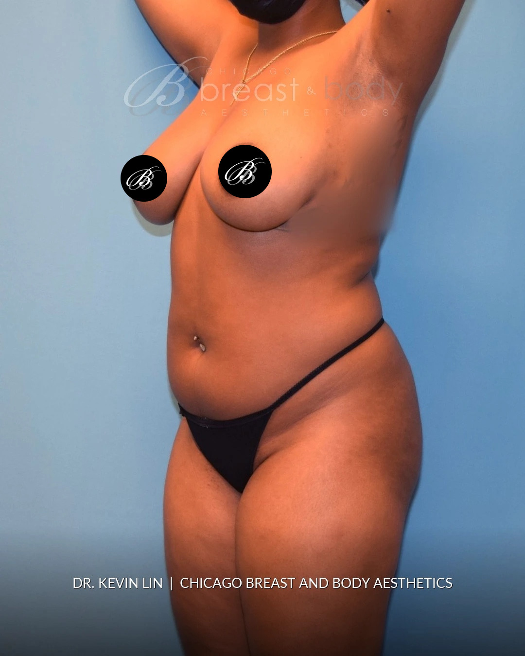 Lipo 360, Liposuction before photo, three-quarter view, case #1540321, Dr. Kevin Lin, Chicago Breast & Body