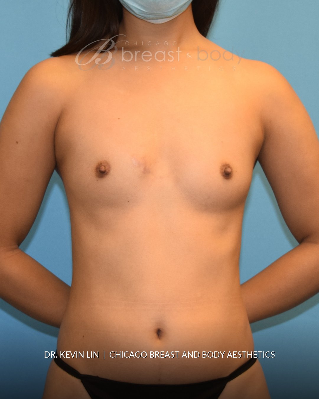 Breast Augmentation before photo, front view, case #1662619, Dr. Kevin Lin, Chicago Breast & Body