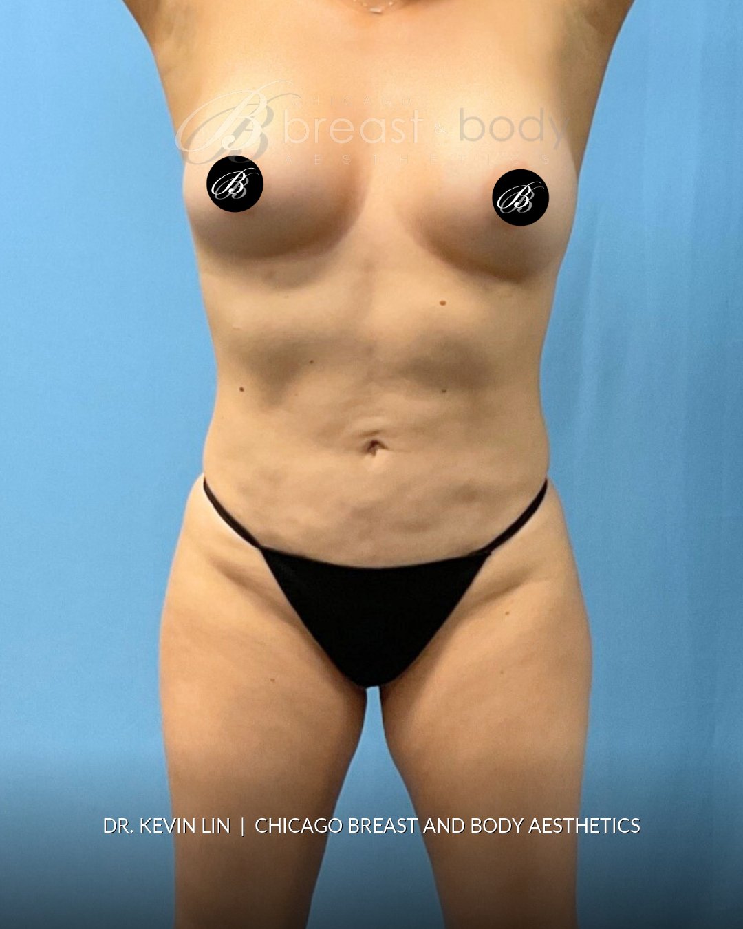 Lipo 360, Liposuction after photo, front view, case #1736549, Dr. Kevin Lin, Chicago Breast & Body
