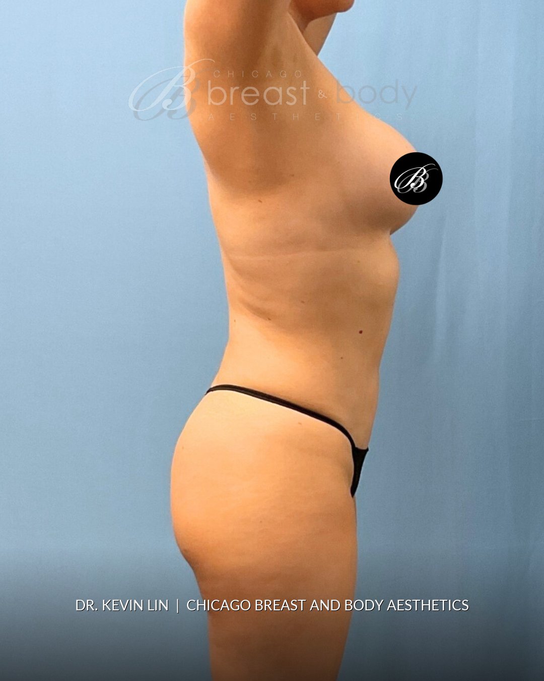 Lipo 360, Liposuction after photo, side view, case #1736549, Dr. Kevin Lin, Chicago Breast & Body
