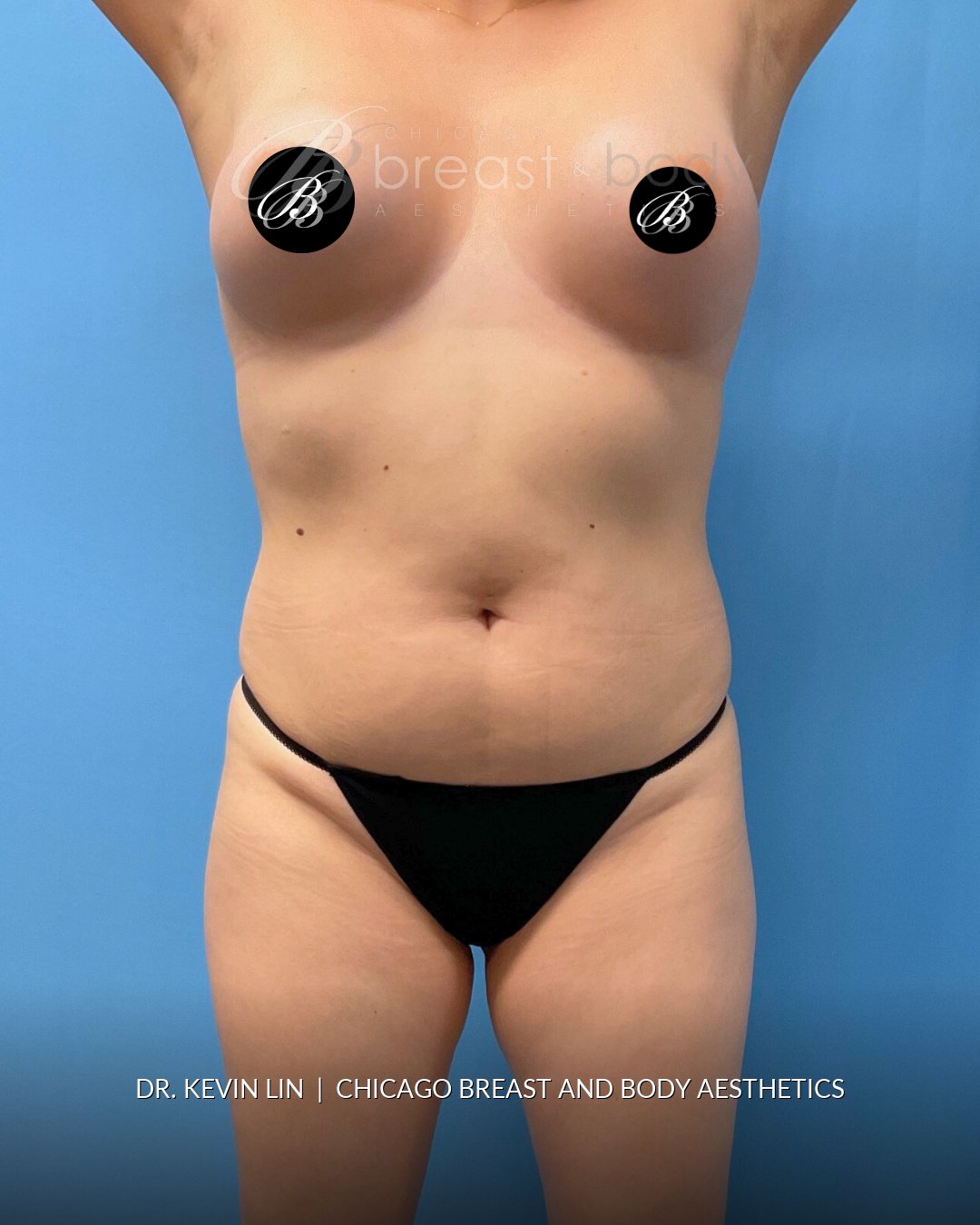 Lipo 360, Liposuction before photo, front view, case #1736549, Dr. Kevin Lin, Chicago Breast & Body