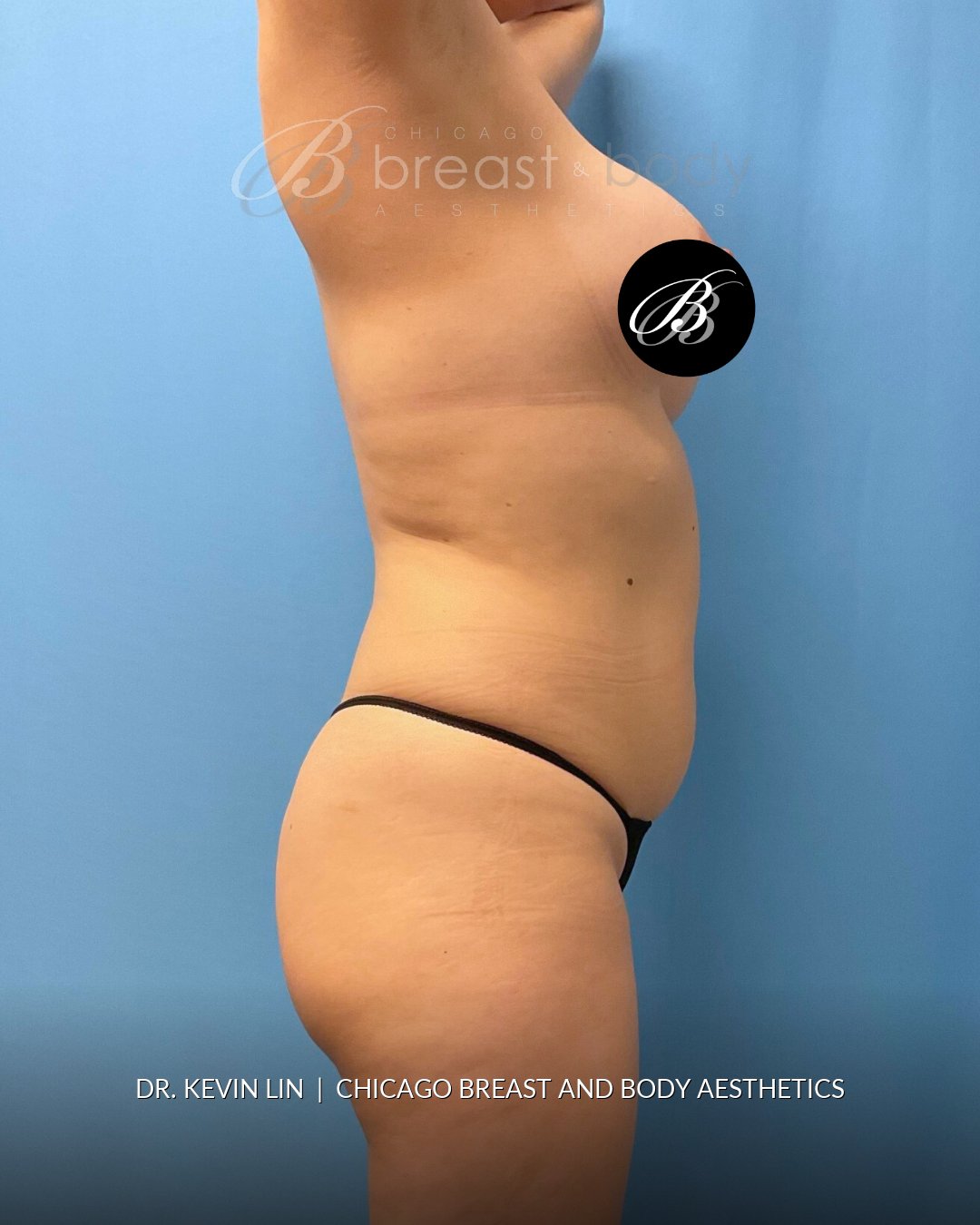 Lipo 360, Liposuction before photo, side view, case #1736549, Dr. Kevin Lin, Chicago Breast & Body