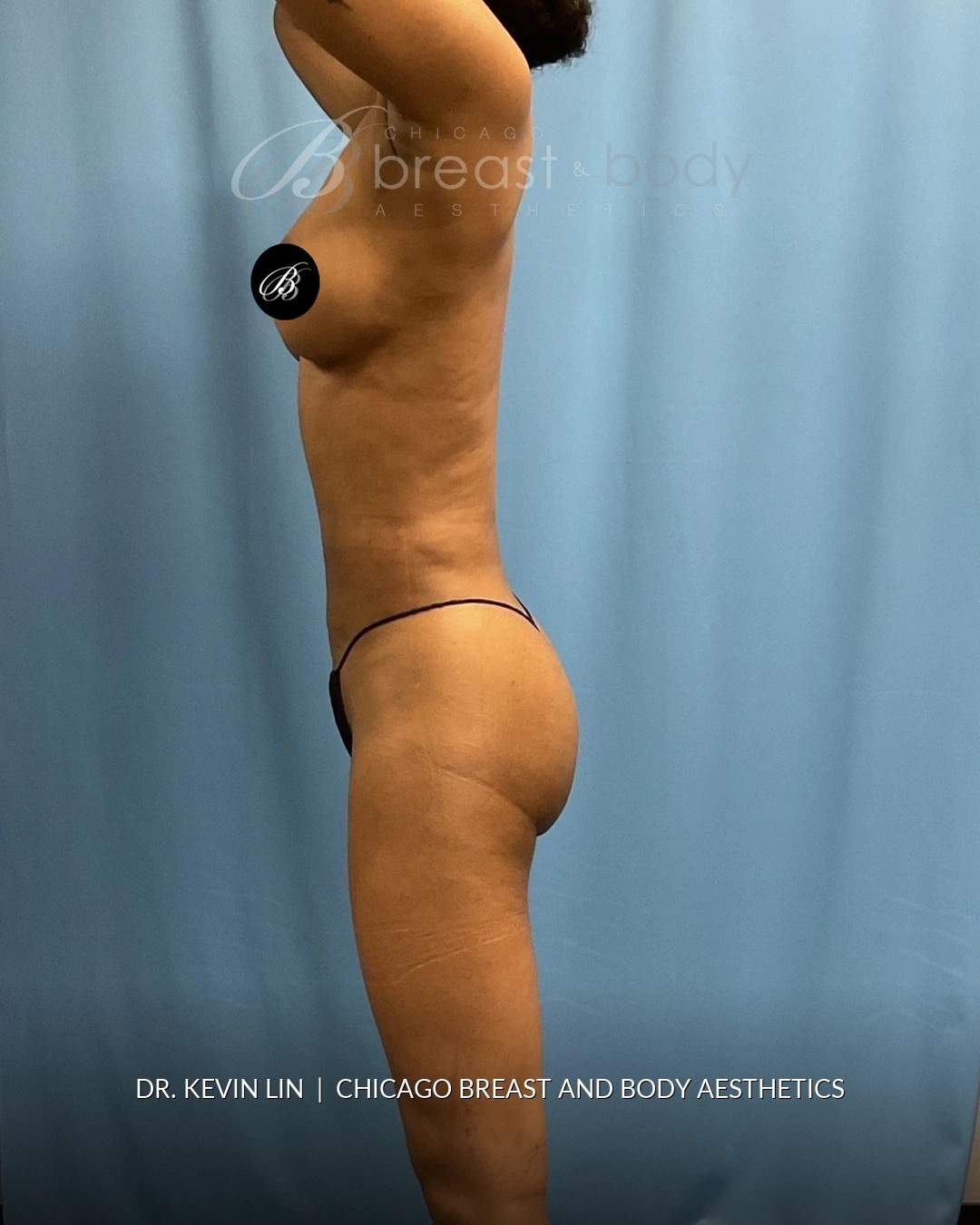 Brazilian Butt Lift, Country Club BBL™, Lipo 360 after photo, side view, case #1977534, Dr. Kevin Lin, Chicago Breast & Body