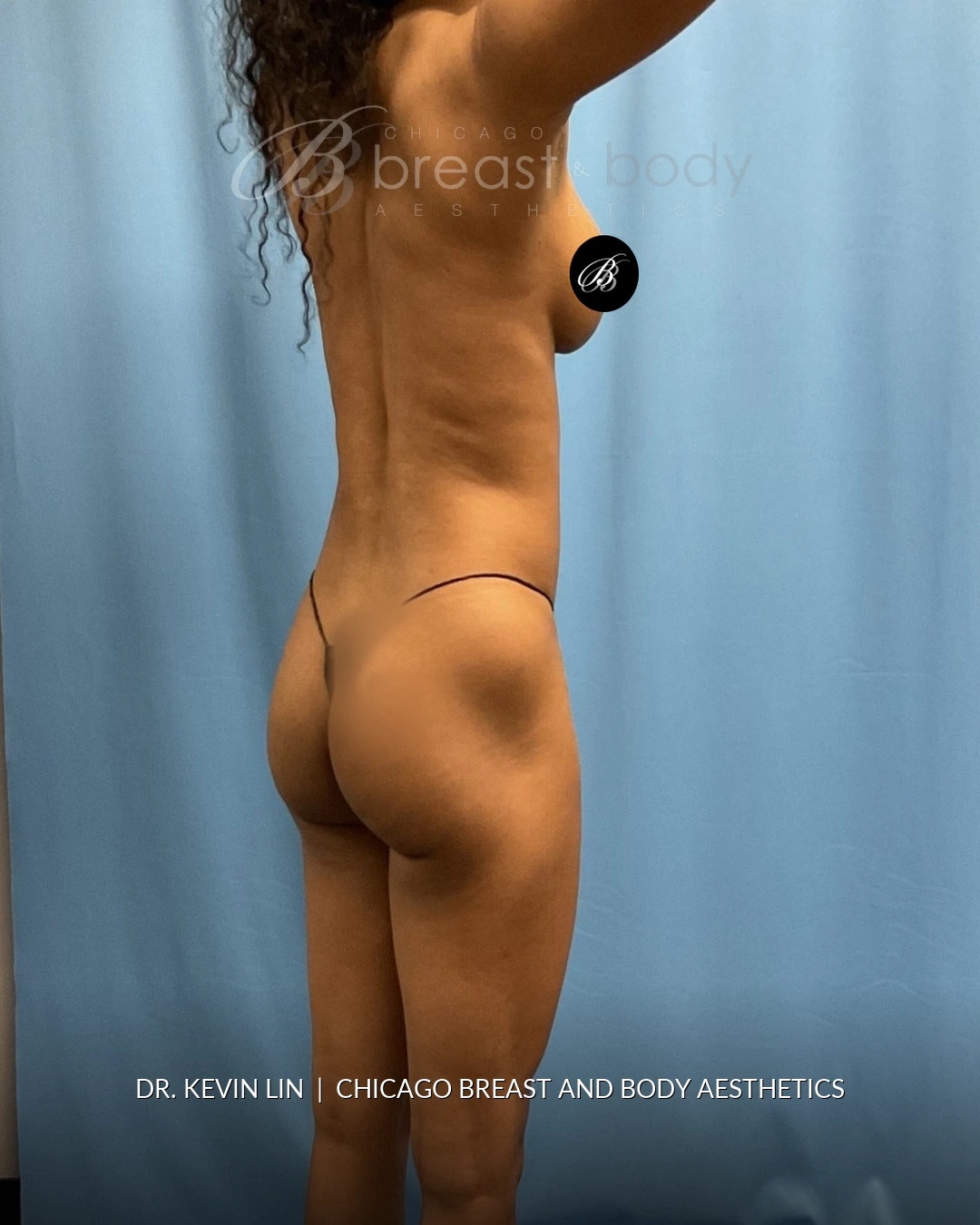 Brazilian Butt Lift, Country Club BBL™, Lipo 360 before photo, oblique view, case #1977534, Dr. Kevin Lin, Chicago Breast & Body