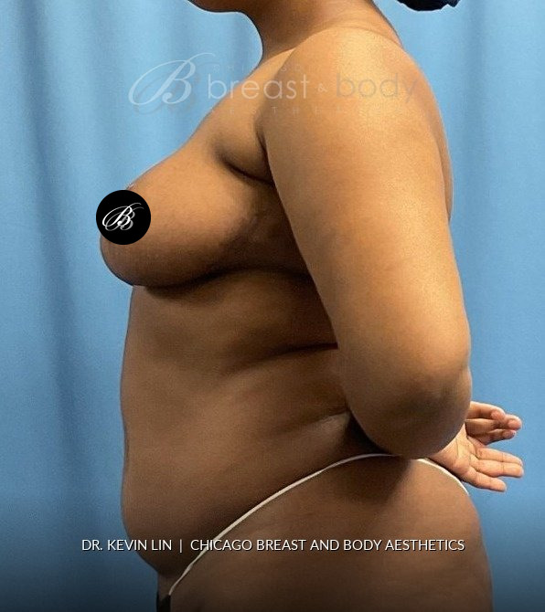 Breast Reduction (Mammaplasty), Internal Bra (Mesh) after photo, side view, case #1977723, Dr. Kevin Lin, Chicago Breast & Body