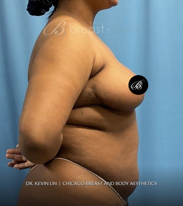 Breast Reduction (Mammaplasty), Internal Bra (Mesh) after photo, side view, case #1977723, Dr. Kevin Lin, Chicago Breast & Body