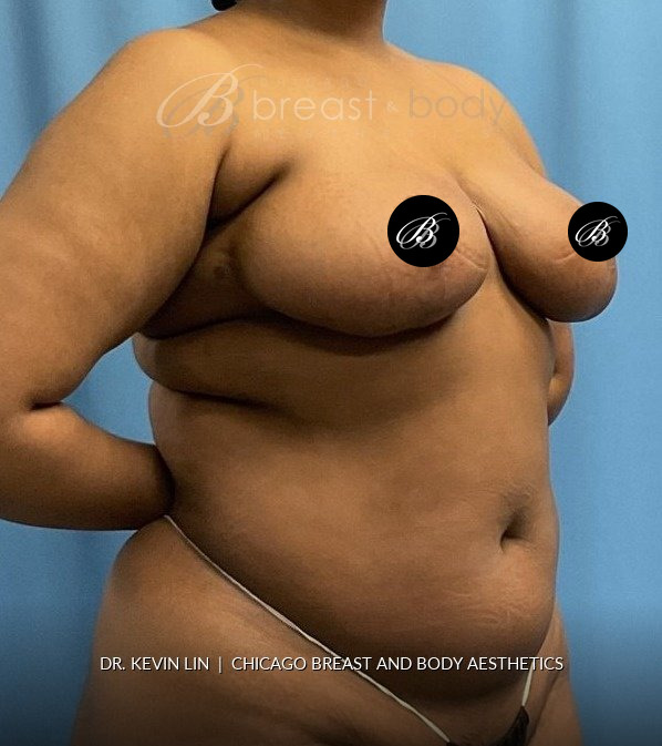 Breast Reduction (Mammaplasty), Internal Bra (Mesh) after photo, three-quarter view, case #1977723, Dr. Kevin Lin, Chicago Breast & Body