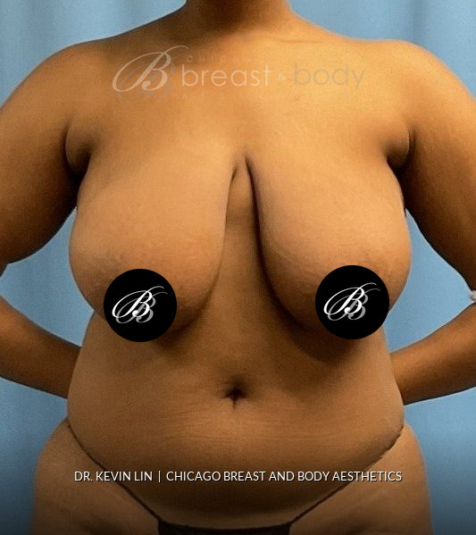 Breast Reduction (Mammaplasty), Internal Bra (Mesh) before photo, front view, case #1977723, Dr. Kevin Lin, Chicago Breast & Body