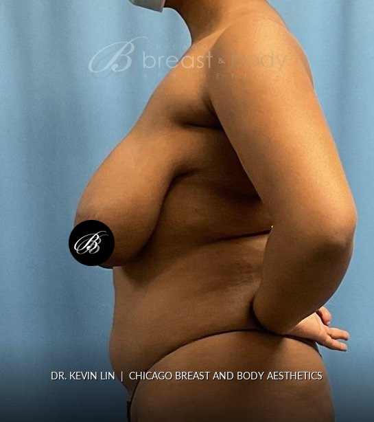 Breast Reduction (Mammaplasty), Internal Bra (Mesh) before photo, side view, case #1977723, Dr. Kevin Lin, Chicago Breast & Body