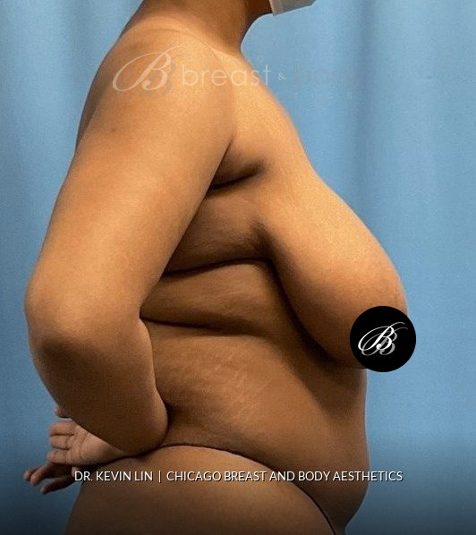 Breast Reduction (Mammaplasty), Internal Bra (Mesh) before photo, side view, case #1977723, Dr. Kevin Lin, Chicago Breast & Body