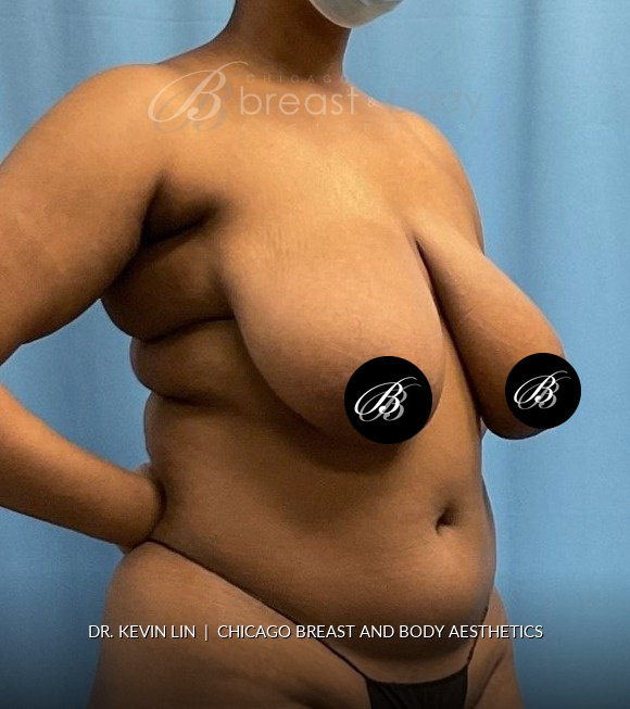 Breast Reduction (Mammaplasty), Internal Bra (Mesh) before photo, three-quarter view, case #1977723, Dr. Kevin Lin, Chicago Breast & Body