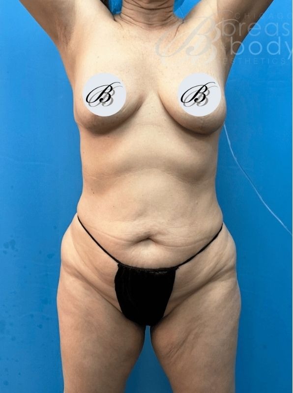 Abdominoplasty (Tummy Tuck), Lipo 360, Lipoabdominoplasty (Tummy Tuck with Liposuction) before photo 1, case #2028188, Dr. Kevin Lin, Chicago Breast & Body