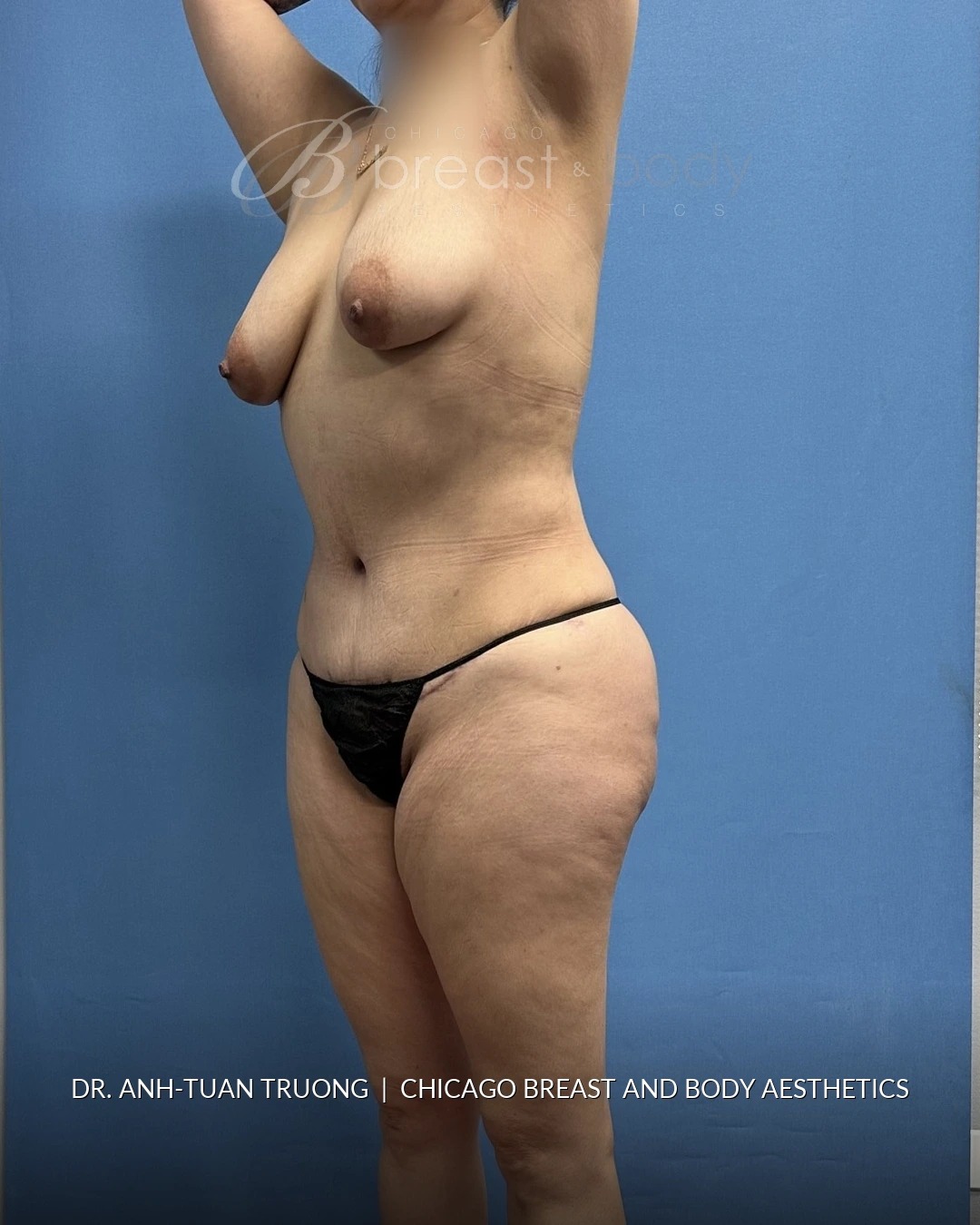 Lipoabdominoplasty (Tummy Tuck with Liposuction), Brazilian Butt Lift after photo 2, case #2305079, Dr. Anh-Tuan Truong, Chicago Breast & Body