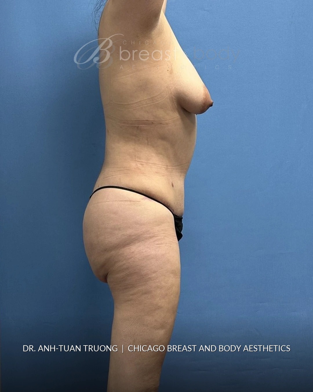 Lipoabdominoplasty (Tummy Tuck with Liposuction), Brazilian Butt Lift after photo 3, case #2305079, Dr. Anh-Tuan Truong, Chicago Breast & Body