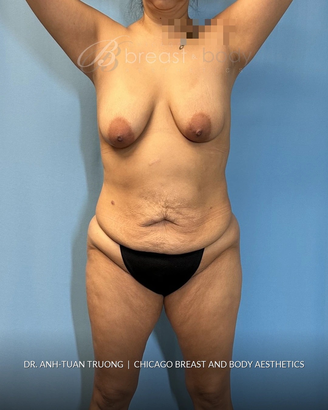 Lipoabdominoplasty (Tummy Tuck with Liposuction), Brazilian Butt Lift before photo 1, case #2305079, Dr. Anh-Tuan Truong, Chicago Breast & Body