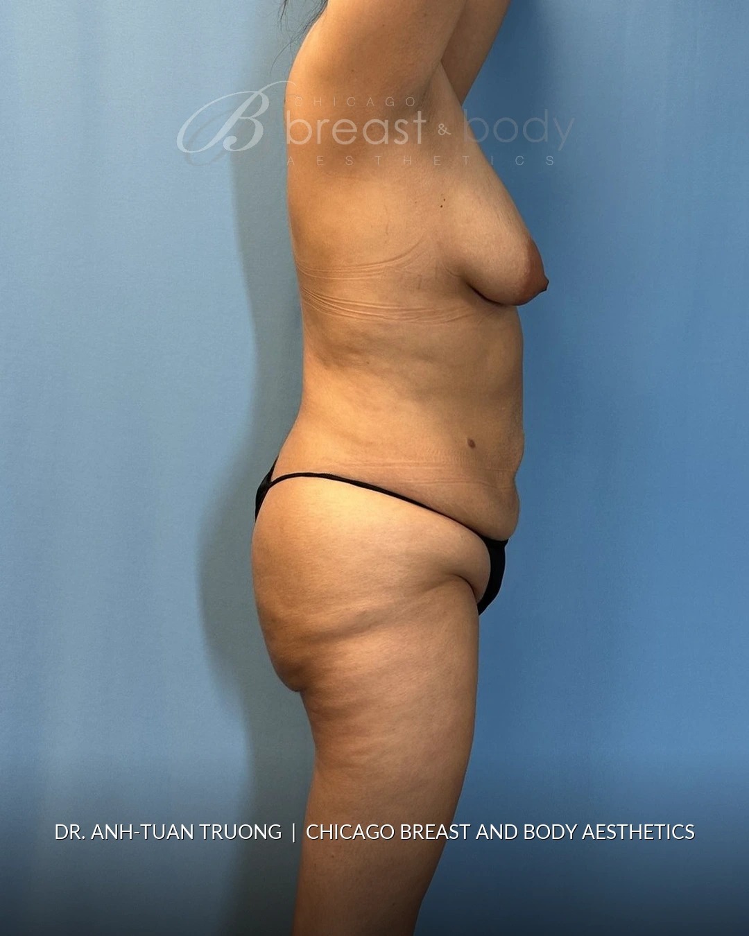 Lipoabdominoplasty (Tummy Tuck with Liposuction), Brazilian Butt Lift before photo 3, case #2305079, Dr. Anh-Tuan Truong, Chicago Breast & Body