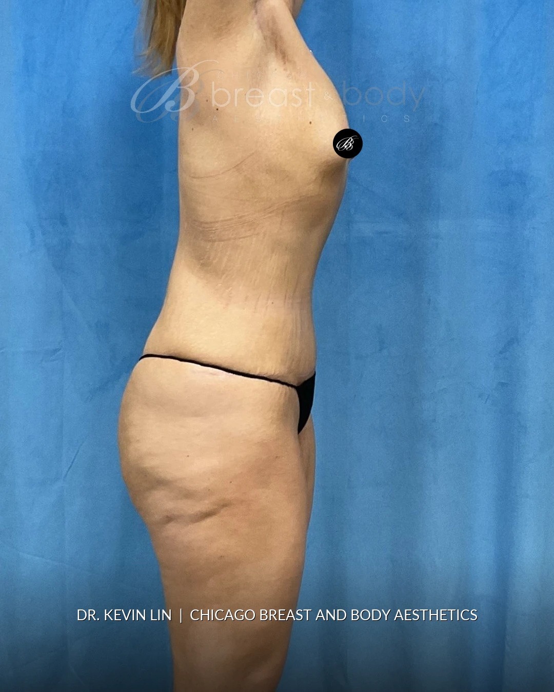 Lipoabdominoplasty (Tummy Tuck with Liposuction), Brachioplasty (Arm Lift) after photo 6, case #2321983, Dr. Kevin Lin, Chicago Breast & Body