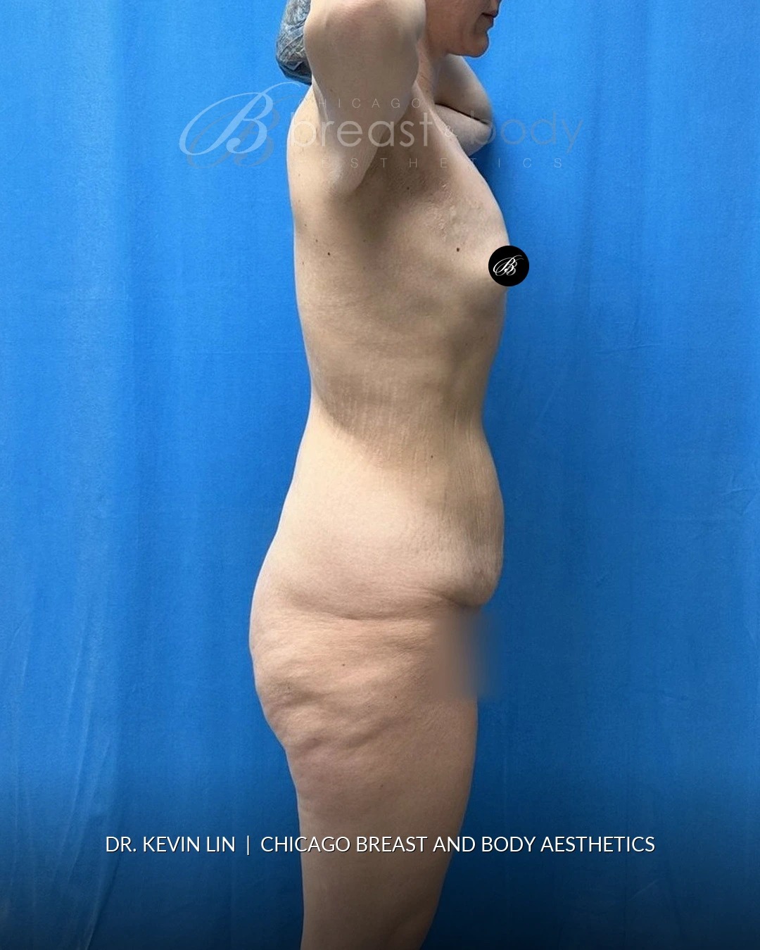 Lipoabdominoplasty (Tummy Tuck with Liposuction), Brachioplasty (Arm Lift) before photo 6, case #2321983, Dr. Kevin Lin, Chicago Breast & Body
