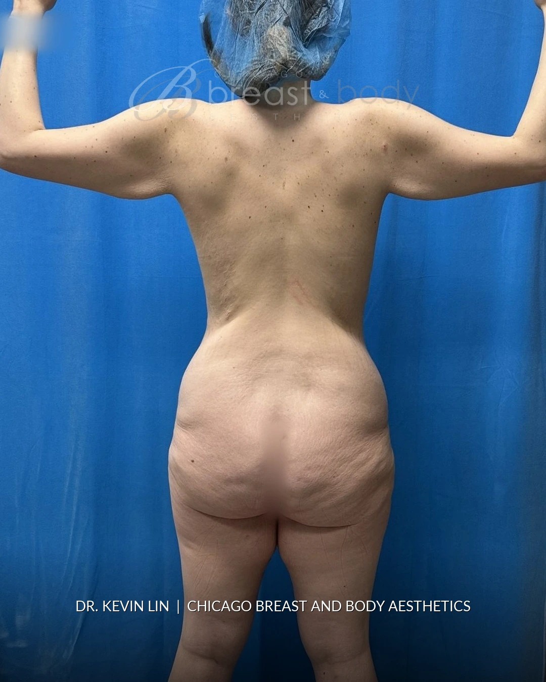 Lipoabdominoplasty (Tummy Tuck with Liposuction), Brachioplasty (Arm Lift) before photo 7, case #2321983, Dr. Kevin Lin, Chicago Breast & Body