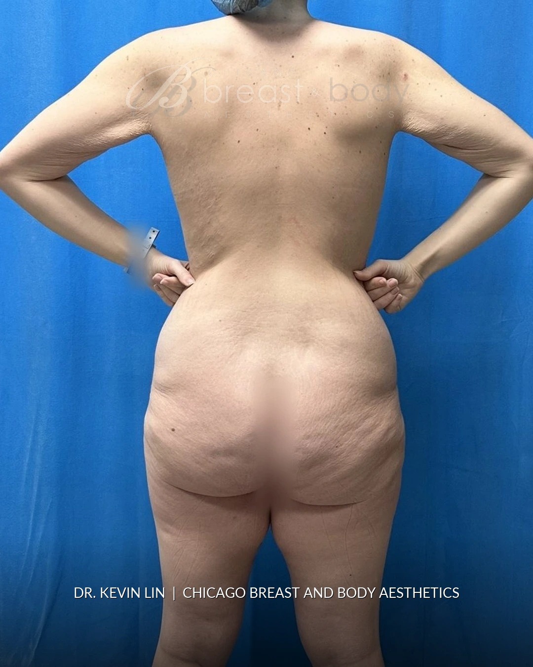 Lipoabdominoplasty (Tummy Tuck with Liposuction), Brachioplasty (Arm Lift) before photo 8, case #2321983, Dr. Kevin Lin, Chicago Breast & Body