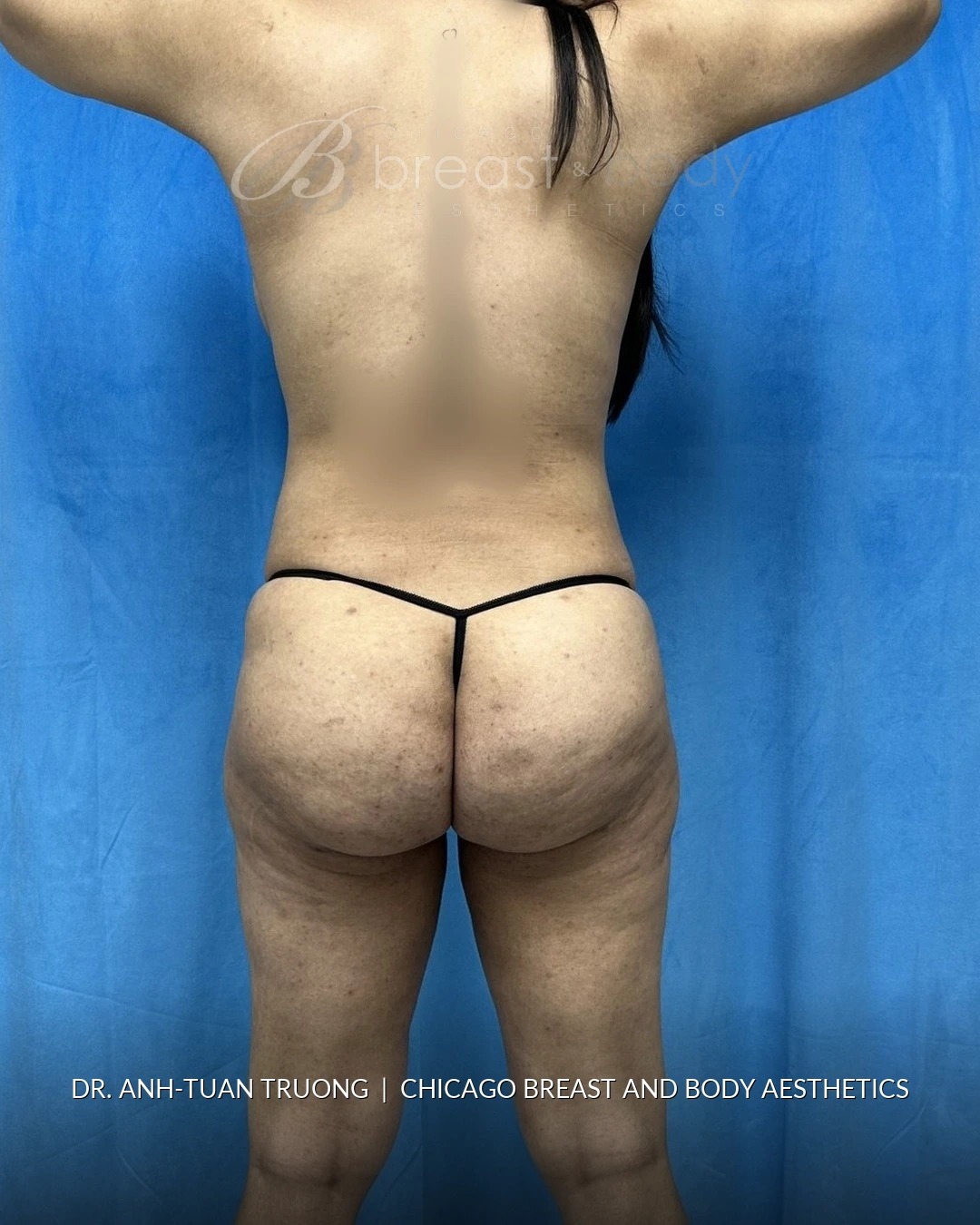Brazilian Butt Lift, Lipo 360, Hip Augmentation after photo, back view, case #2358724, Dr. Anh-Tuan Truong, Chicago Breast & Body